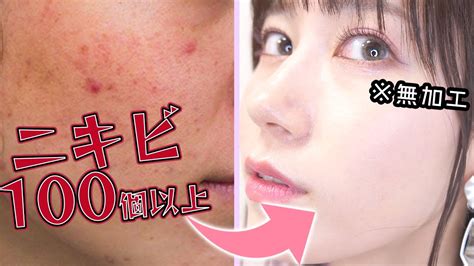 100個以上できたニキビを全滅させた私のスキンケア方法 Youtube