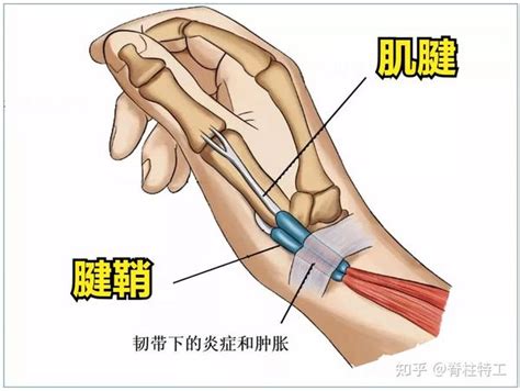 腱鞘炎3个阶段专业康复怎么做 知乎