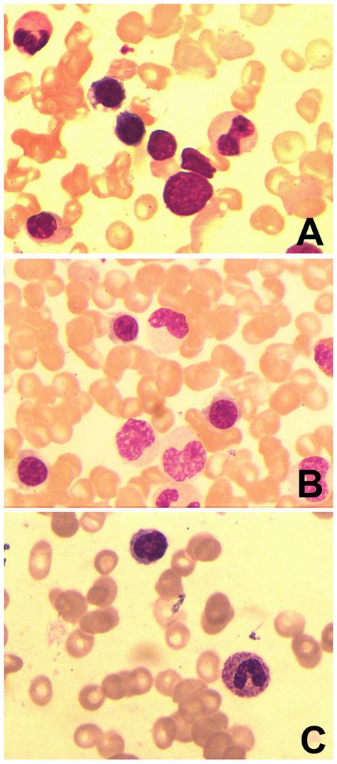 Bone Marrow Cytology Image Of Aspiration Smear Bone Marrow Samples Of Download Scientific