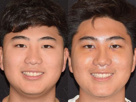 Ethnic Rhinoplasty Asian Male Rhinoplasty Before And After — Kassir Plastic Surgery In Ny And Nj