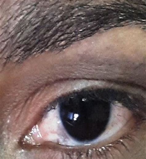 A Blue Brown Macules On Left Peri Orbital Area And Few Bluish