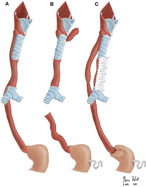 Frontiers Esophageal Trachea A Unique Foregut Malformation Requiring