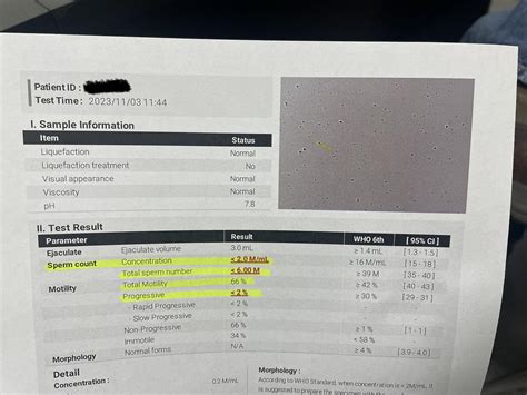 Results after vasectomy reversal : r/maleinfertility