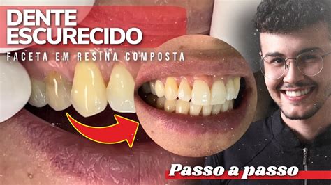 Dente Escurecido Faceta Em Resina Composta Tutorial Youtube