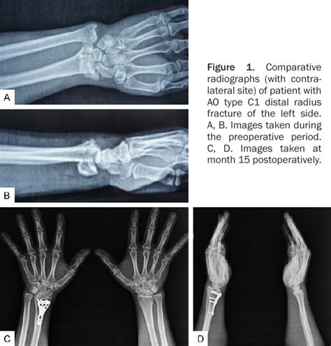 Figure 1 From Comparison Of Open Reduction Volar Locking Plate Fixation