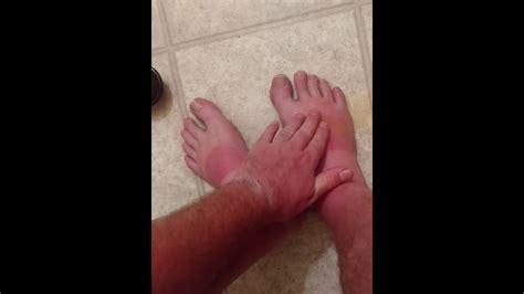 Popping My Blister On My Sunburnt Foot Youtube