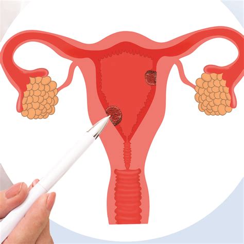 Abnormal Uterine Bleeding – Women's Clinic BTM – Dr Brunda Channappa ...