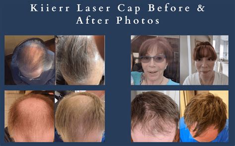 Laser Caps Vs Hair Transplant Surgery Which Should You Try First