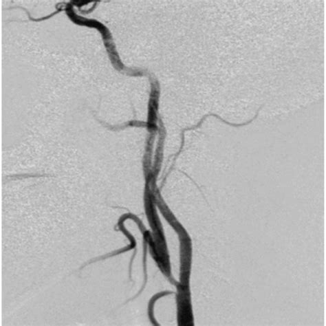 After Carotid Artery Stenting A Well Deployed Carotid Stent Was Seen Download Scientific