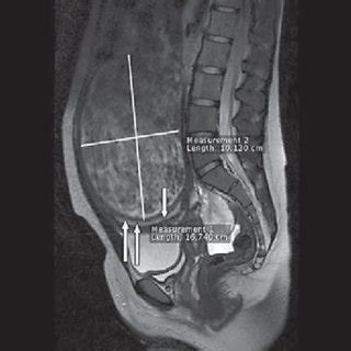 Preoperative Mri Sagittal T Weighted Tr Te Scans Show A