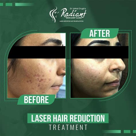 Best Laser Hair Reduction Treatment In Jaipur Radiant Skin And Ent Clinic