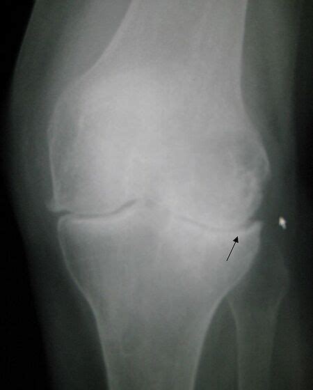 Osteoarthritis Physiopedia