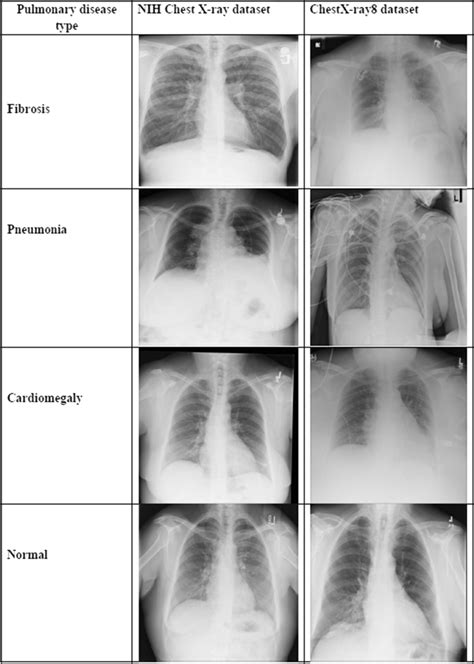 Sample Images Of Selected Pulmonary Diseases From NIH Chest X Ray As