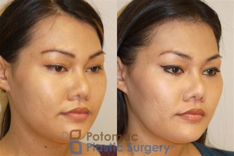 Facial Sculpting Before After Photos Patient Washington Dc