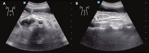 Transverse (A) and longitudinal (B) ultrasonography of the epigastrium ...