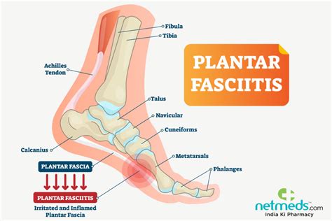 Plantar Fasciitis Heel Pain Causes Signs Symptoms Diagnosis