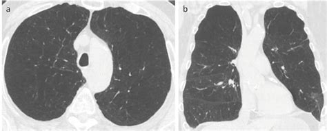 Imaging Of Emphysema A Comprehensive Review Intechopen