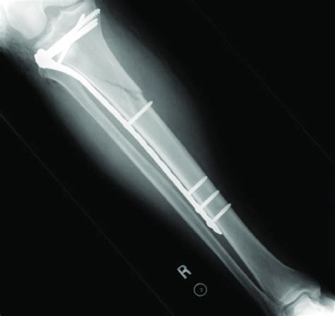 Postoperative Anteroposterior X Ray Download Scientific Diagram