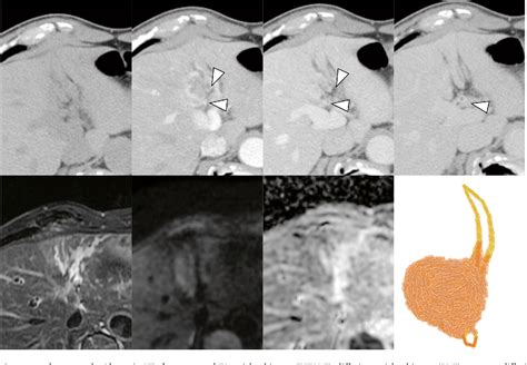 Figure 2 From Imaged Periductal Infiltration Diagnostic And Prognostic