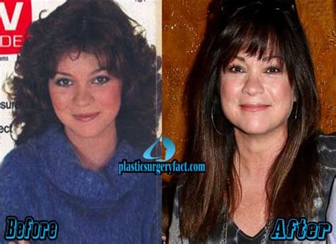 Valerie Bertinelli Plastic Surgery Before and After