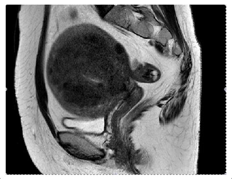 Diffuse Type Adenomyosis T2 Weighted Magnetic Resonance Image