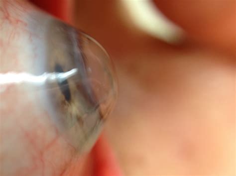 Cornea Transplant Photo Gallery