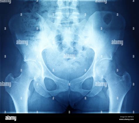 Pelvis x ray Stock Photo - Alamy