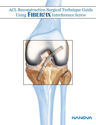 ACL Technique Guide FiberFix Nanova