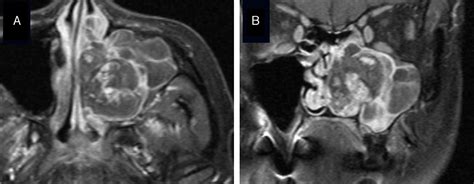 Scielo Brasil Maxillary Sinus Hemangioma Usefulness Of