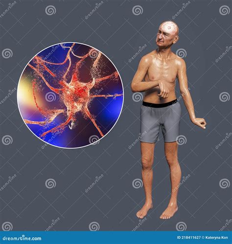 A Person with Chorea Disease and Close-up View of Neuronal Degradation Stock Illustration ...