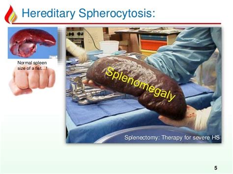 Spherocytosis Ask Hematologist Understand Hematology