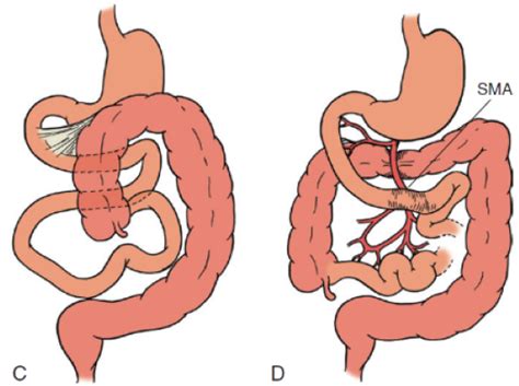 Incidental Intestinal Malrotation During Rygb