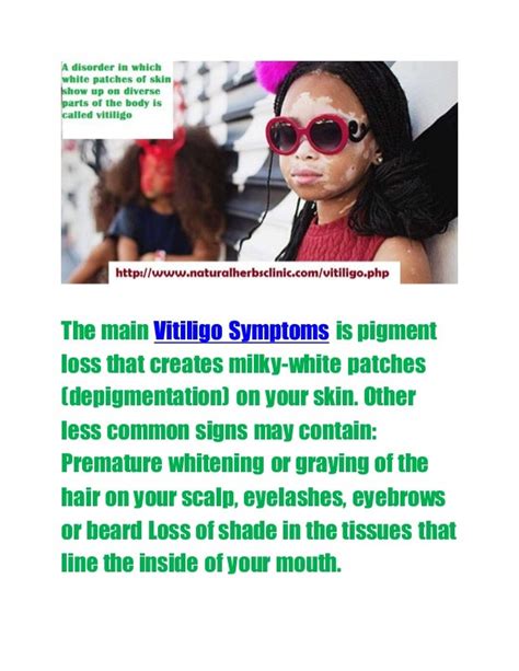 Vitiligo symptoms & signs