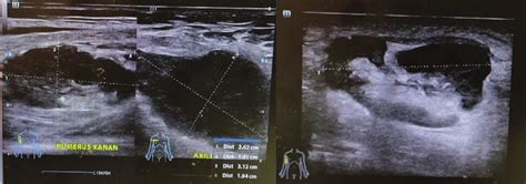 Right axilla diagnostic ultrasound. The image shows axillary... | Download Scientific Diagram