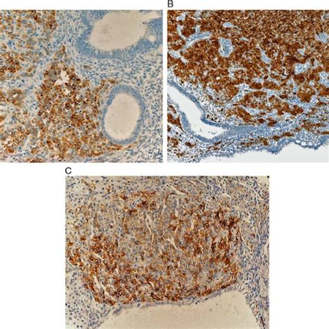 Immunohistochemical Features Of Extensive Sex Cord Like Components A