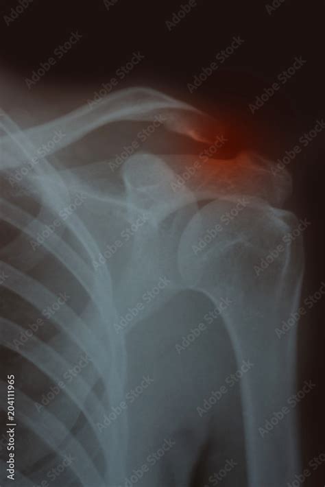 X-ray of the shoulder joint part. Stock Photo | Adobe Stock