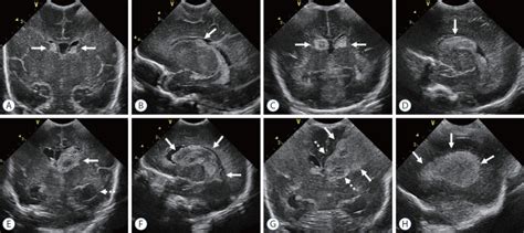 Neuroimaging Of Germinal Matrix And Intraventricular Hemorrhage In