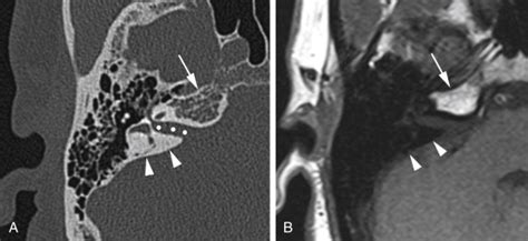 Petrous Apex | Radiology Key