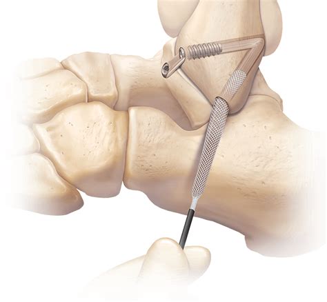 Arthrex Lateral Ankle Ligament Reconstruction