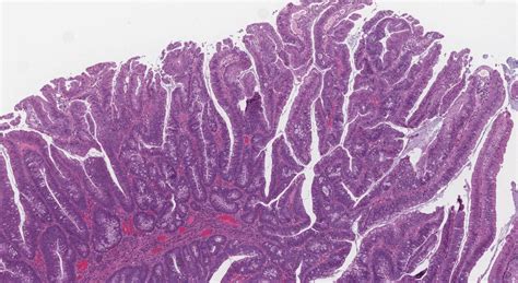 Tubulovillous adenoma of the colon | Atlas of Pathology