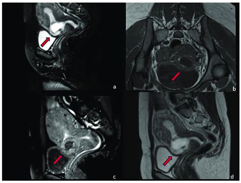 Csp Type Ii Sagittal T2 Weighted Fat Saturation A Axial Download Scientific Diagram