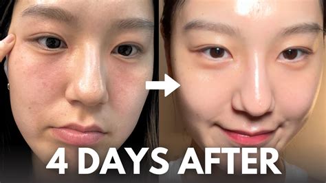 How I Repair My Skin Barrier In 4 Days At Home With Affordable