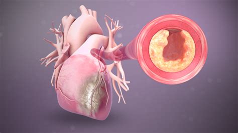 Myocardial Infarction (Heart Attack): Symptoms, Causes, and Treatment