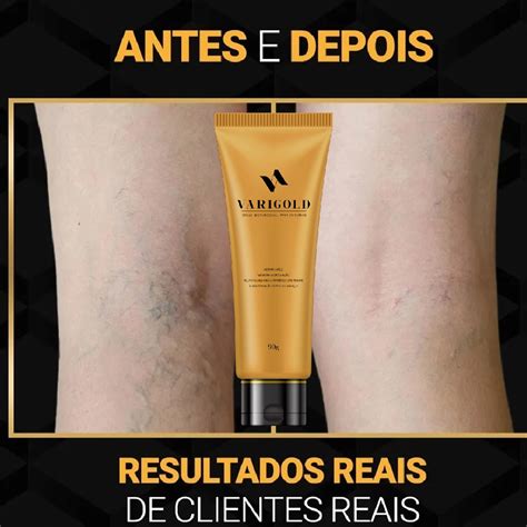 Creme Para Varizes Varigold Tratamento Veias Nas Pernas Frete Grátis