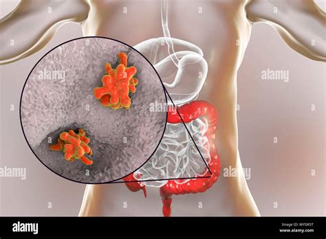 Parasitic Amoeba Entamoeba Histolytica In The Large Intestine Computer Illustration This