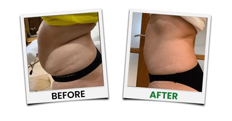 Cold Fat Removal Treatment Emerald Laser By Erchnoia