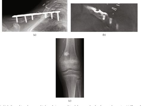 Figure From Use Of A Free Vascularized Medial Femoral Condyle Flap