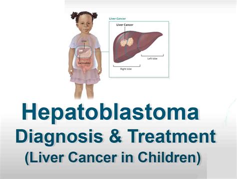 Liver Cancer Causes Symptoms Diagnosis And Treatment Options Page 4 Of 16 Healthella