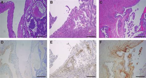 Representative Photographs Of Ovarian Clear Cell Carcinoma Arising In