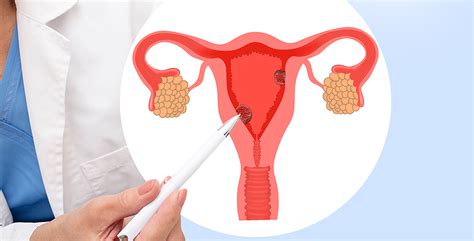 Cofepris Autoriza Un Medicamento Contra El C Ncer De Endometrio